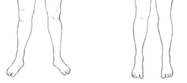 Comparison from "Pain Free" by Pete Egoscue of functional and dysfunctional bodies