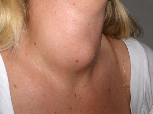 A woman exhibiting goiter