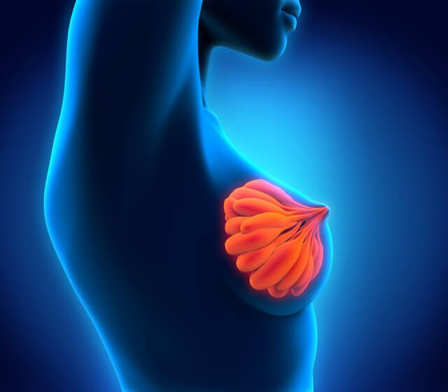 Breast cancer illustrated