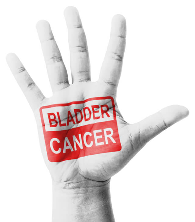 "Bladder cancer" are stamped on a hand
