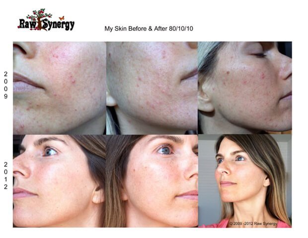 Photos showing Alicia Grant's skin before and after adopting a low-fat raw food diet