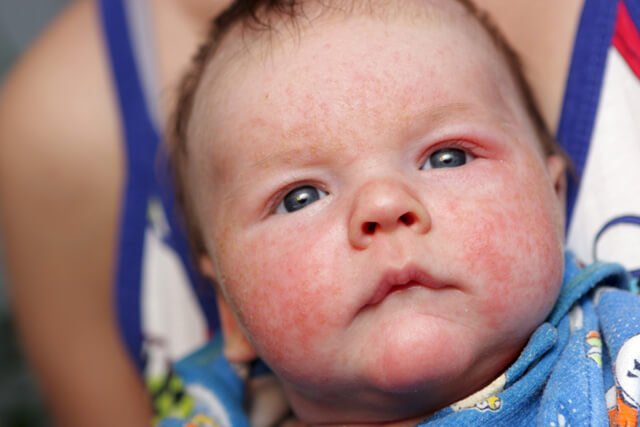 A baby with eczema on its face