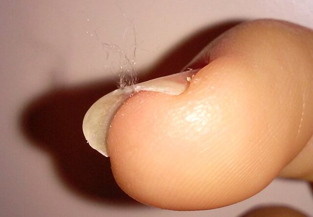 Morgellons on fingernail
