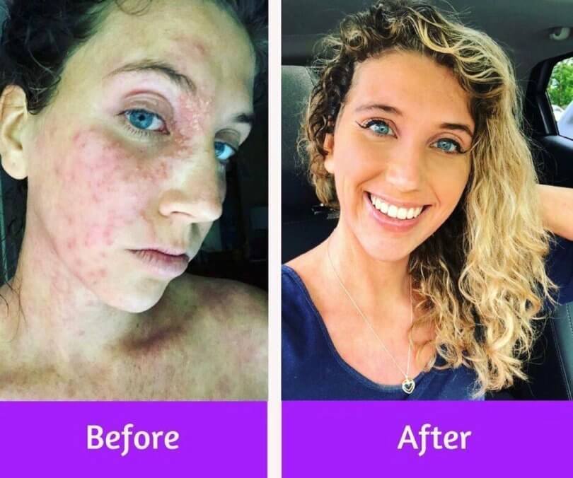 Caileigh Feldman - before and after eczema herpeticum - chronic eczema - topical steroid withdrawal - Fruit-Powered
