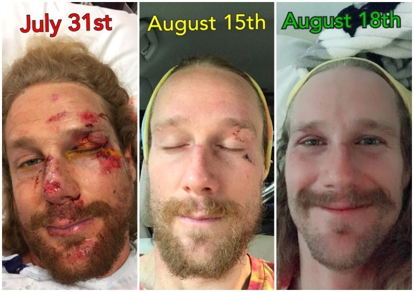 Chris Kendall - motorcycle crash recovery progress - Fruit-Powered